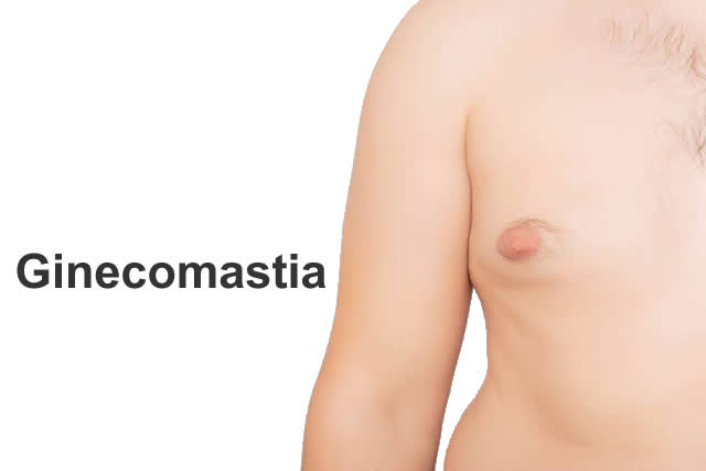 GINECOMASTIA EN QUITO