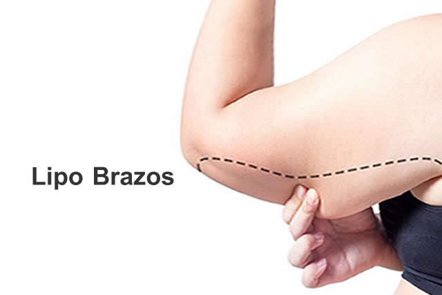 LIPO BRAZOS QUITO 